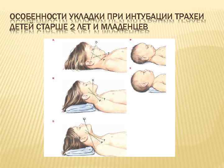 ОСОБЕННОСТИ УКЛАДКИ ПРИ ИНТУБАЦИИ ТРАХЕИ ДЕТЕЙ СТАРШЕ 2 ЛЕТ И МЛАДЕНЦЕВ 