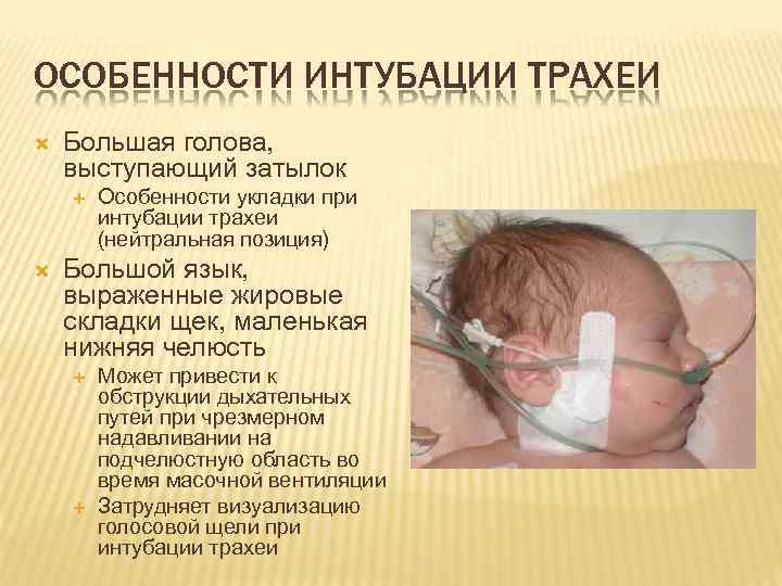 ОСОБЕННОСТИ ИНТУБАЦИИ ТРАХЕИ Большая голова, выступающий затылок Особенности укладки при интубации трахеи (нейтральная позиция)