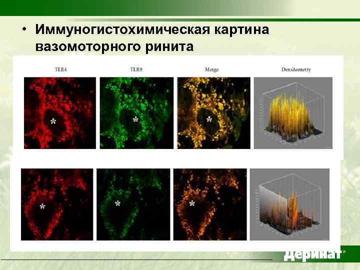  • Иммуногистохимическая картина вазомоторного ринита 