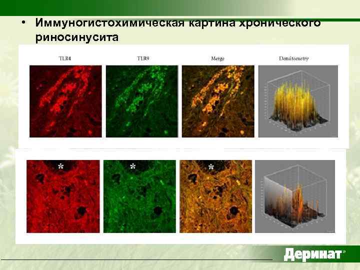  • Иммуногистохимическая картина хронического риносинусита 