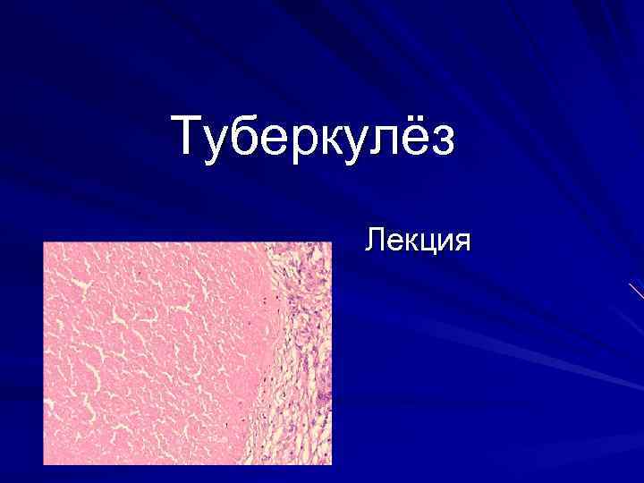 Туберкулёз Лекция 