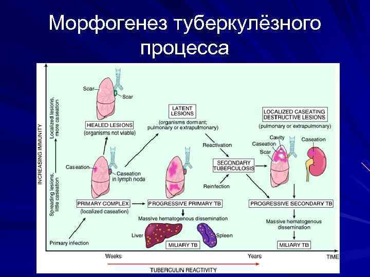 Морфогенез туберкулёзного процесса 