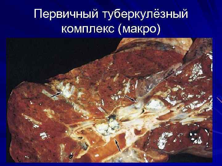 Первичный туберкулёзный комплекс (макро) 