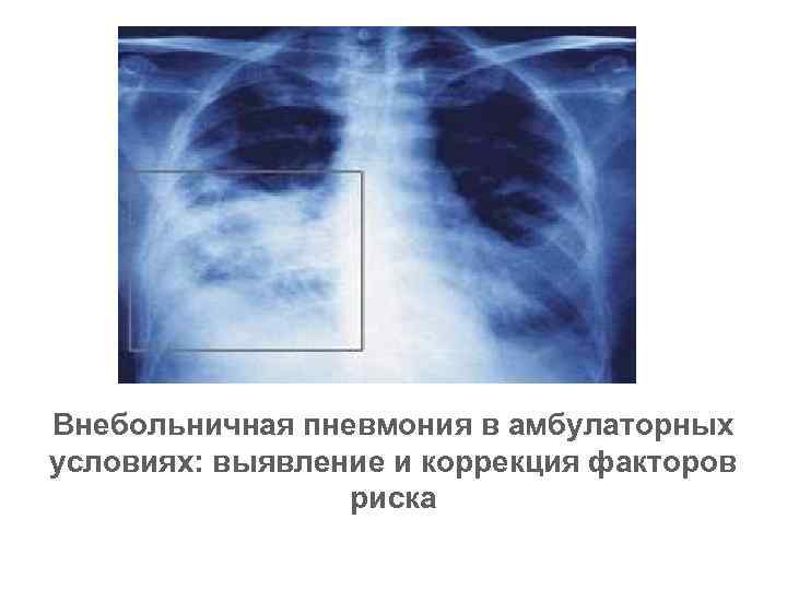 Внебольничная пневмония в амбулаторных условиях: выявление и коррекция факторов риска 