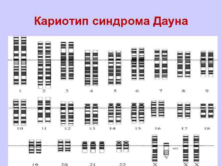 Кариотип дауна. Кариотип больных с синдромом Дауна. Кариотип человека с синдромом Дауна. Кариотип при синдроме Дауна. Кариотип больного с синдромом Дауна.