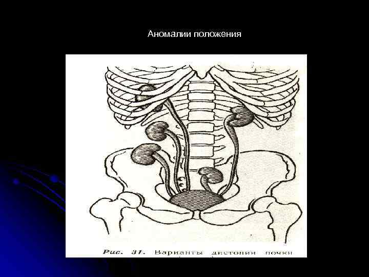 Аномалии положения 