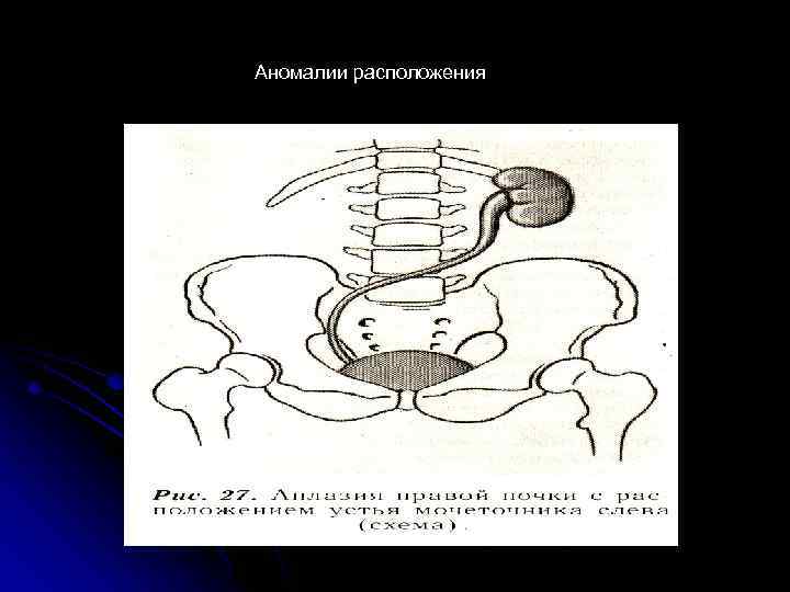 Аномалии расположения 