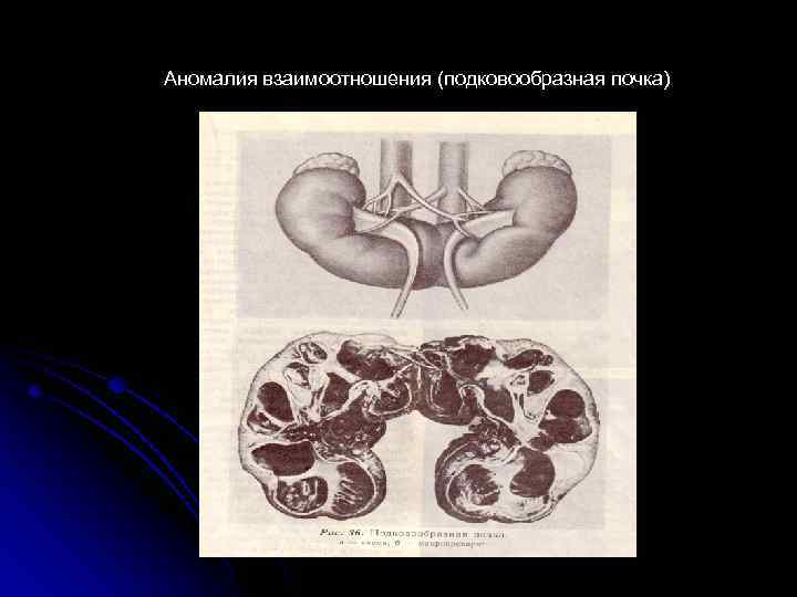 Аномалия взаимоотношения (подковообразная почка) 