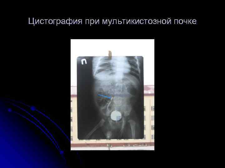 Цистография при мультикистозной почке 