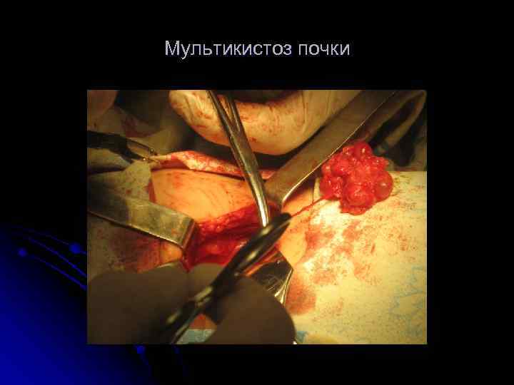 Мультикистоз почки 