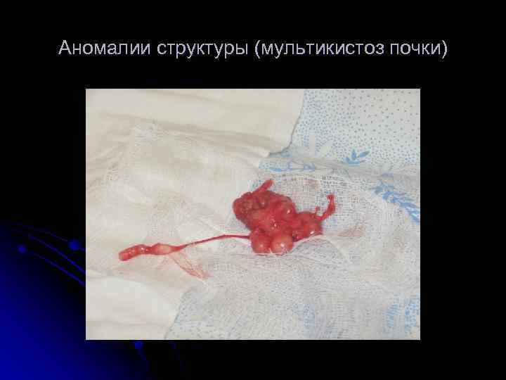 Аномалии структуры (мультикистоз почки) 