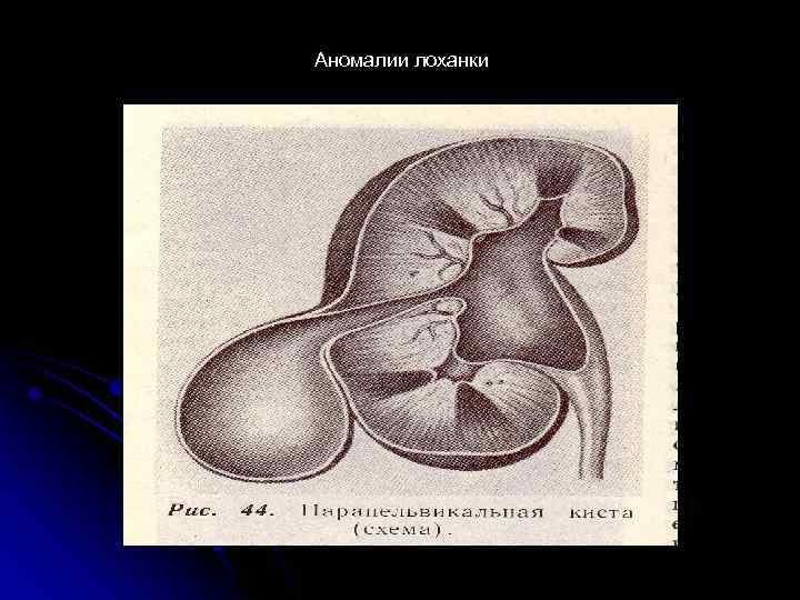 Аномалии лоханки 