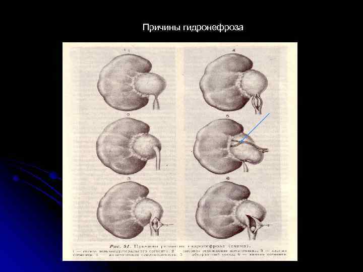 Причины гидронефроза 