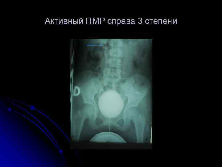 Активный ПМР справа 3 степени 