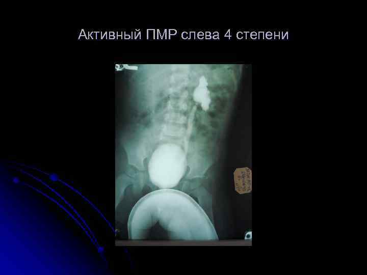 Активный ПМР слева 4 степени 