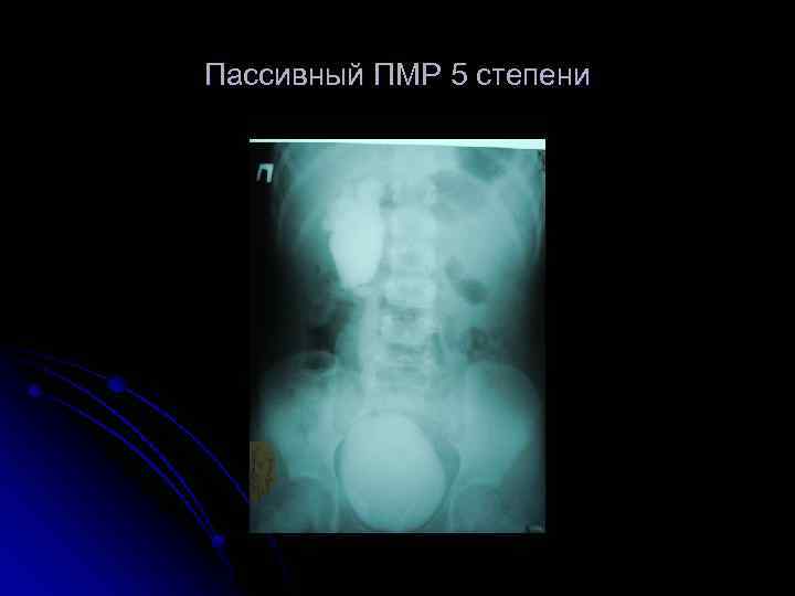 Пассивный ПМР 5 степени 