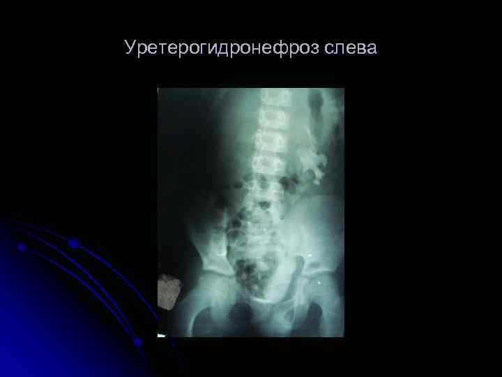 Уретерогидронефроз слева 