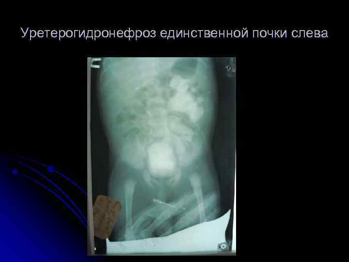 Уретерогидронефроз единственной почки слева 
