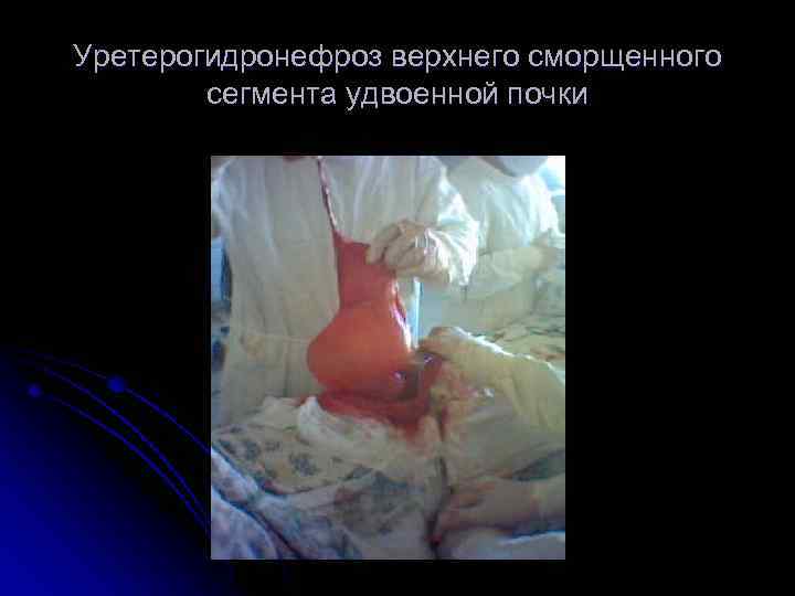 Уретерогидронефроз верхнего сморщенного сегмента удвоенной почки 