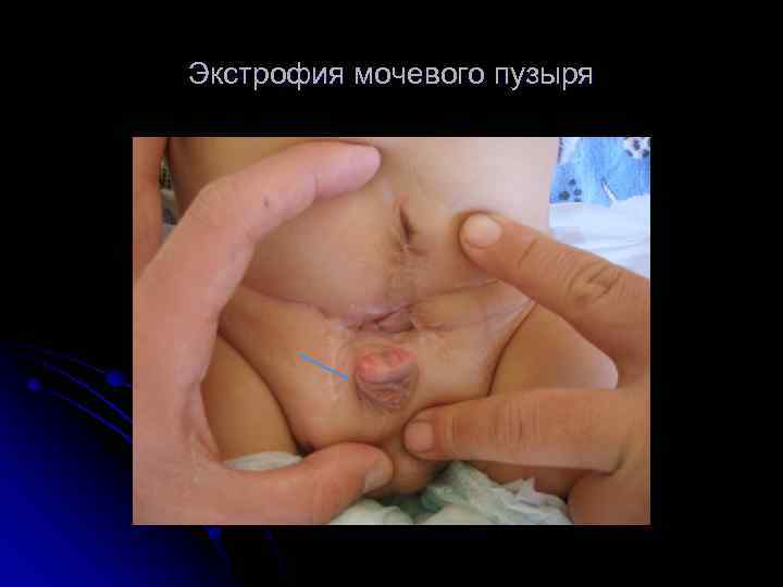 Экстрофия мочевого пузыря 