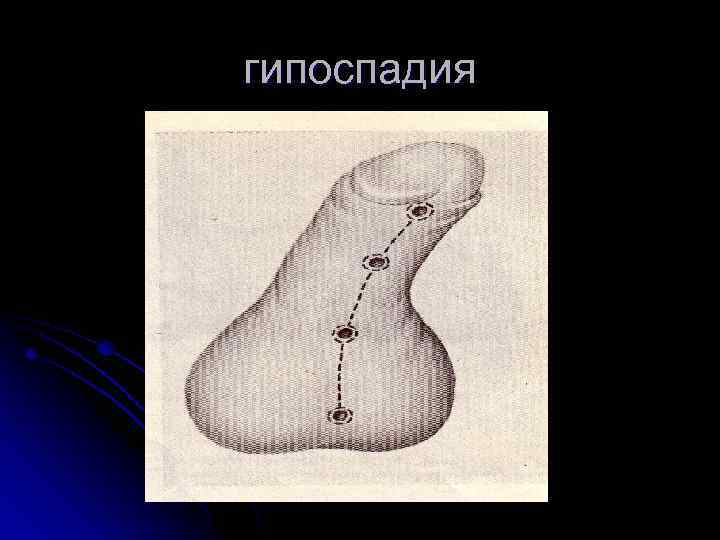 гипоспадия 