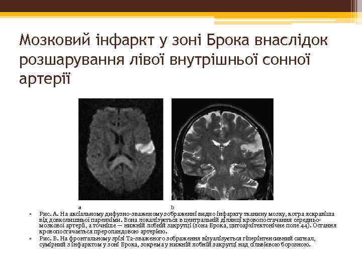 Мозковий інфаркт у зоні Брока внаслідок розшарування лівої внутрішньої сонної артерії • • Рис.