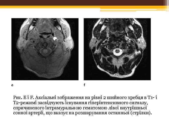 Рис. Е і F. Аксіальні зображення на рівні 2 шийного хребця в Т 1