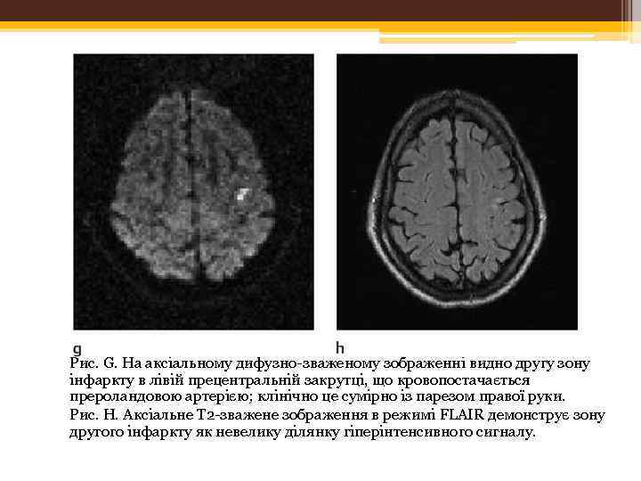 Рис. G. На аксіальному дифузно-зваженому зображенні видно другу зону інфаркту в лівій прецентральній закрутці,