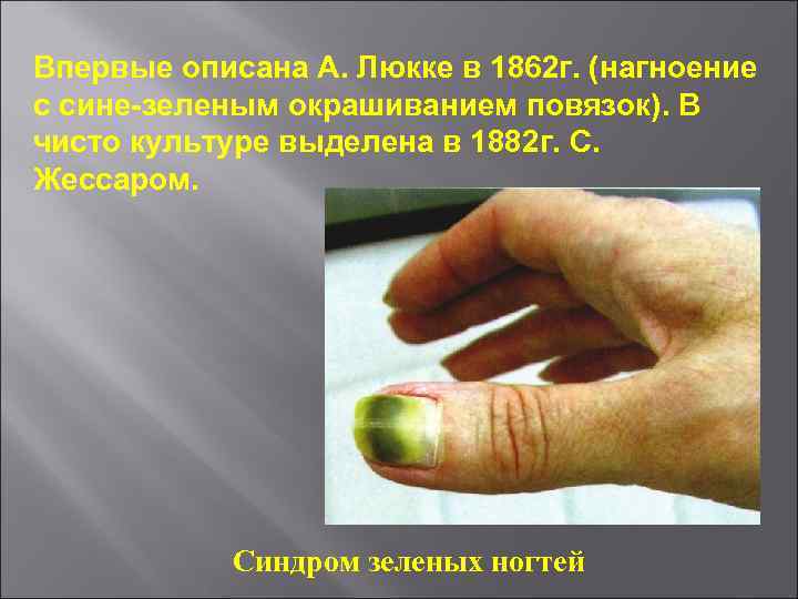 Впервые описана А. Люкке в 1862 г. (нагноение с сине-зеленым окрашиванием повязок). В чисто