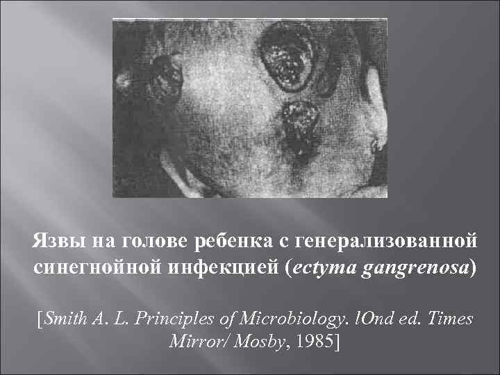 Язвы на голове ребенка с генерализованной синегнойной инфекцией (ectyma gangrenosa) [Smith A. L. Principles