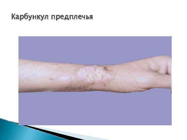 Карбункул предплечья 