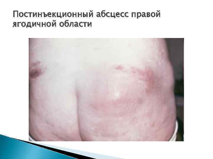 Постинъекционный абсцесс правой ягодичной области 