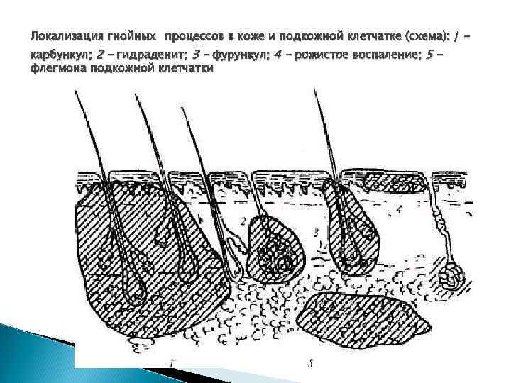 Локализация гнойных процессов в коже и подкожной клетчатке (схема): / карбункул; 2 - гидраденит;