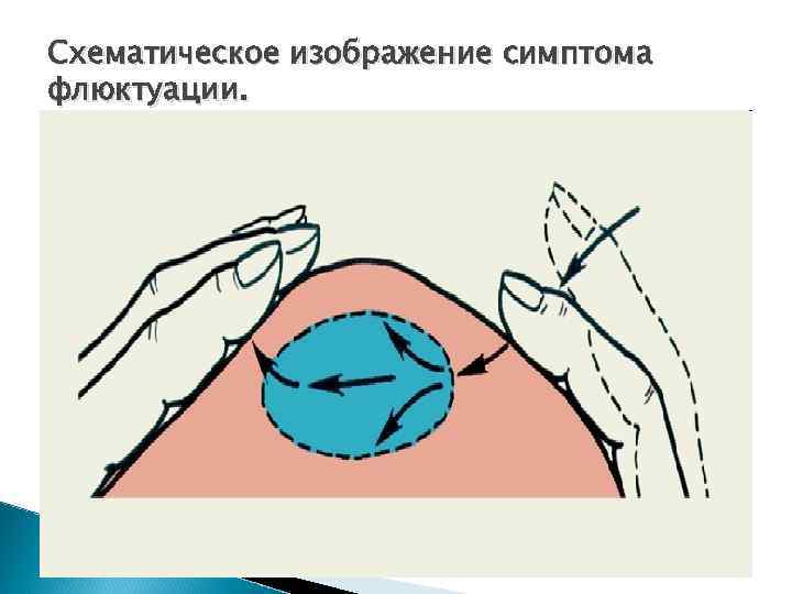 Схематическое изображение симптома флюктуации. 