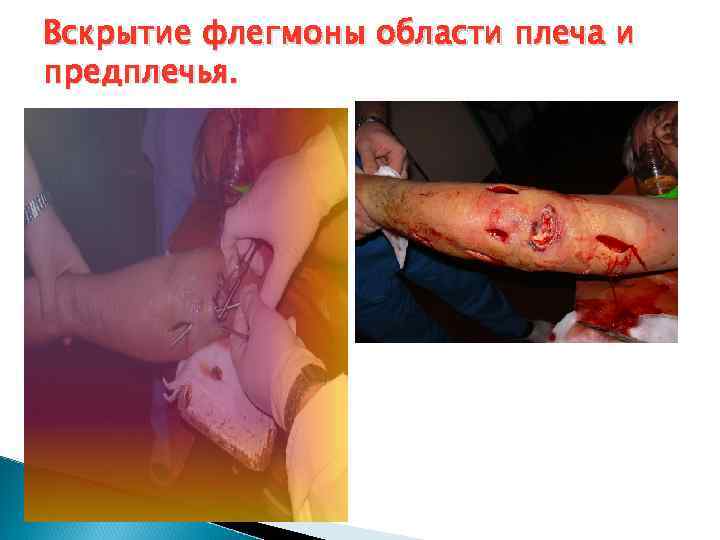 Вскрытие флегмоны области плеча и предплечья. 