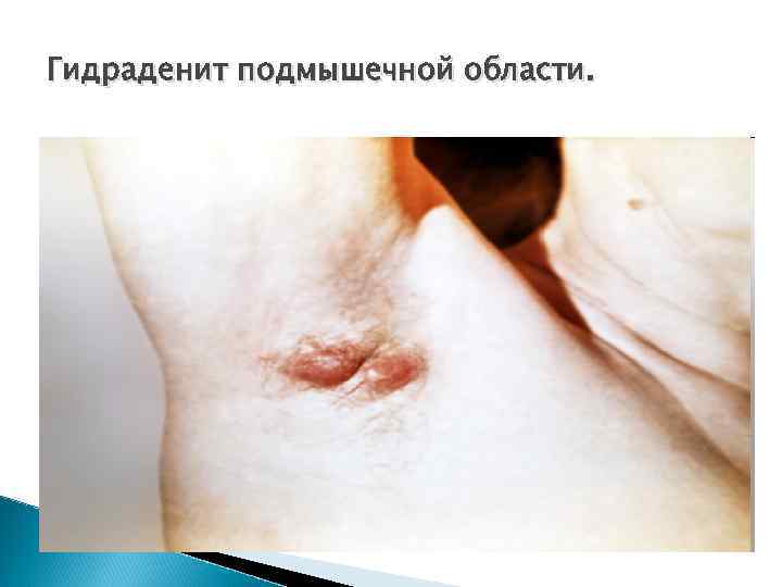 Гидраденит подмышечной области. 