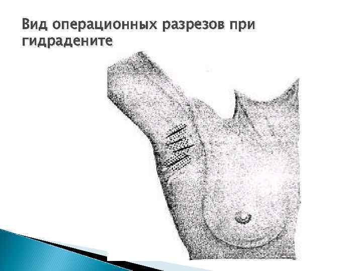 Вид операционных разрезов при гидрадените 