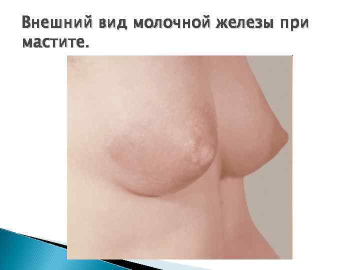 Внешний вид молочной железы при мастите. 