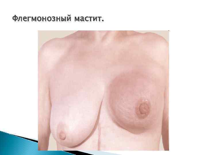 Флегмонозный мастит. 