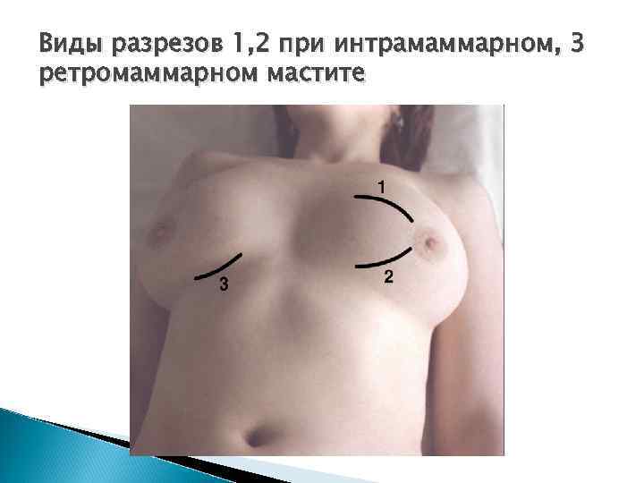 Виды разрезов 1, 2 при интрамаммарном, 3 ретромаммарном мастите 