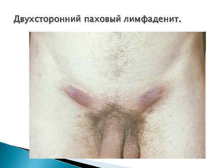 Двухсторонний паховый лимфаденит. 