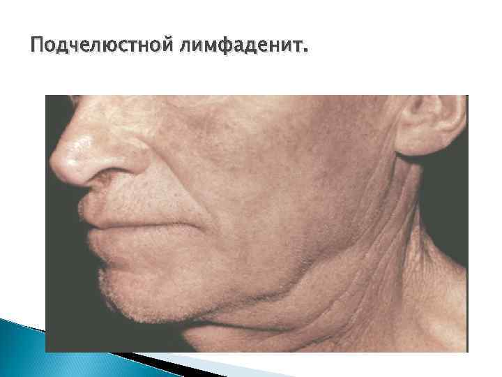 Подчелюстной лимфаденит. 