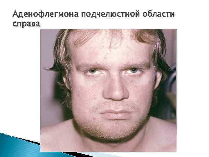 Аденофлегмона подчелюстной области справа 