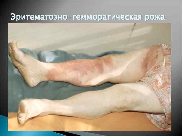 Эритематозно-гемморагическая рожа 