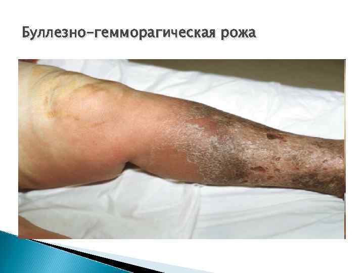Буллезно-гемморагическая рожа 