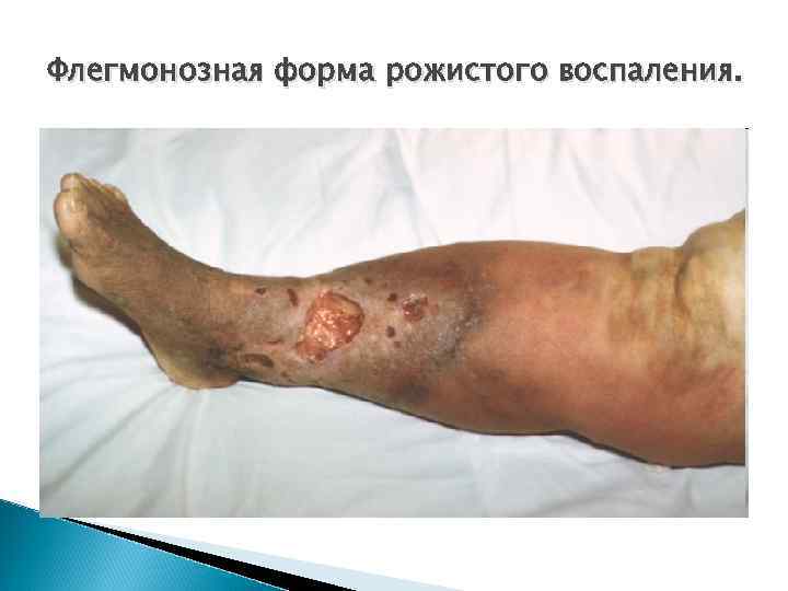 Флегмонозная форма рожистого воспаления. 
