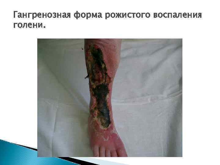 Гангренозная форма рожистого воспаления голени. 