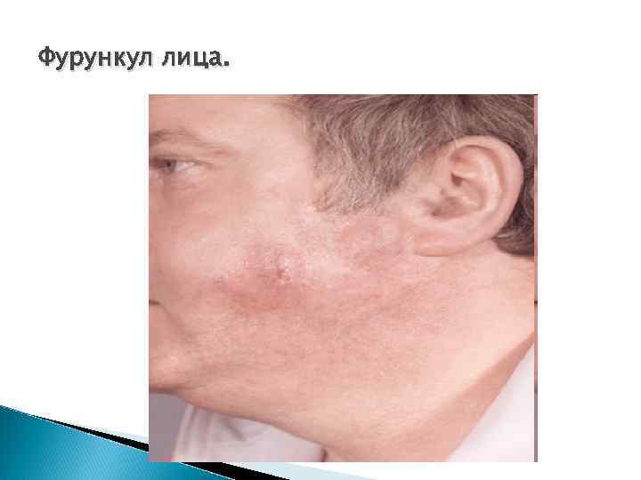 Фурункул лица. 