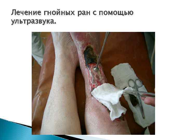 Лечение гнойных ран с помощью ультразвука. 
