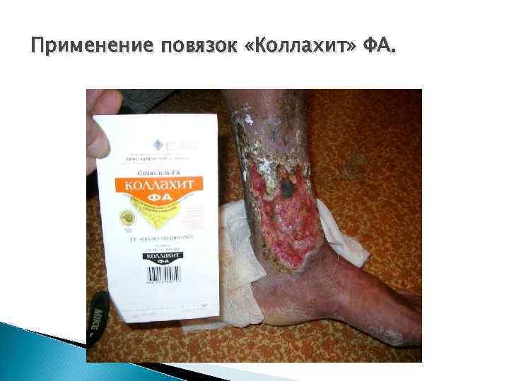Применение повязок «Коллахит» ФА. 
